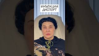 Результаты инъекций Дисплеи #ботокс