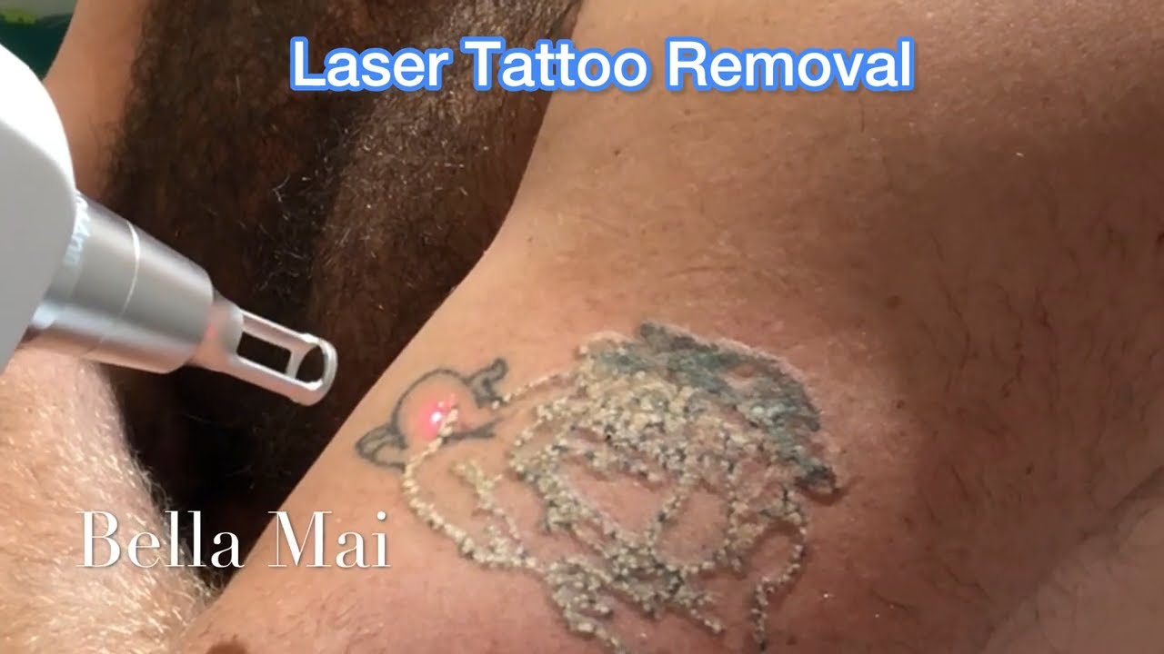 Laser Tattoo Removal - Second Treatment - YouTube