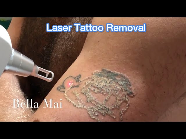 Fantastic results from just 2 sessions :-) #newskin #wrexham #tattooremoval  #lasertattooremoval #laserremoval #fadeth… | Tattoo removal, Tattoos, Skin  color tattoos