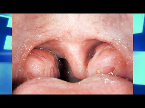 Does Removing the Tonsils Lead to More Future Diseases?