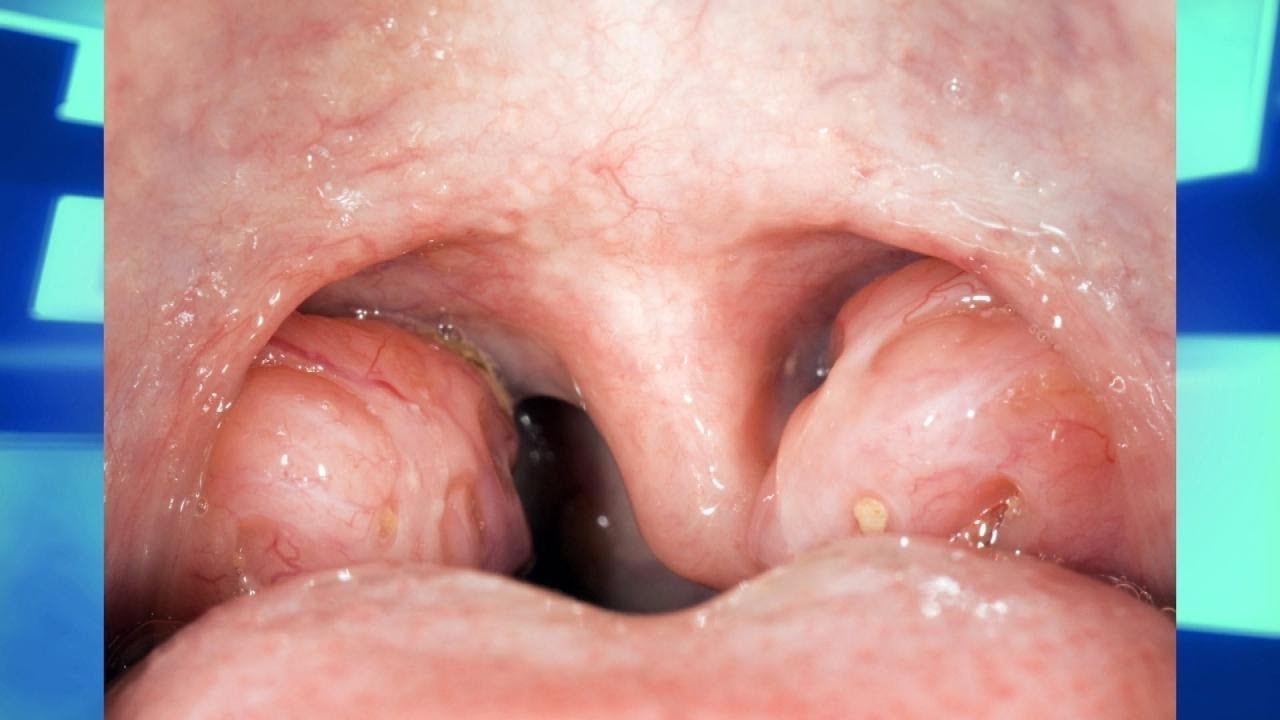 Does Removing The Tonsils Lead To More Future Diseases Youtube