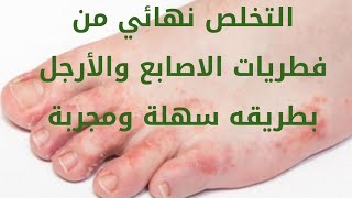 علاج سحري لفطريات الاصابع والأرجل من (الطب الصيني) الأسباب والوقاية والعلاج هو ده الحل الامثل