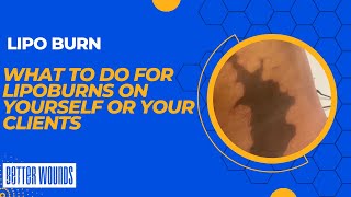 Recovery after liposuction: What to do with lipoburn