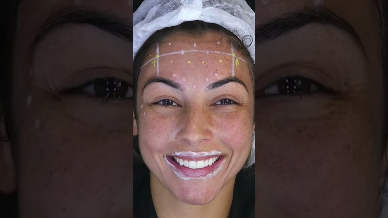 Marca&ccedil;&atilde;o e Resultado de Toxina Botul&iacute;nica