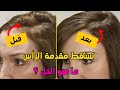 ❤️مشكلة تساقط الشعر في مقدمة الرأس ✂️ طرق نمو الشعر في مقدمة الرأس ◀️