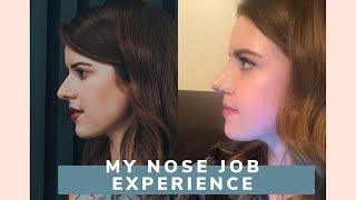 My Nose Job Experience