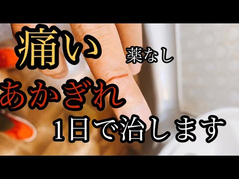 手荒れ、痛いあかぎれ　手荒れ２０年のベテランが治します