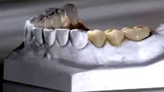 видео Несъемное протезирование зубов