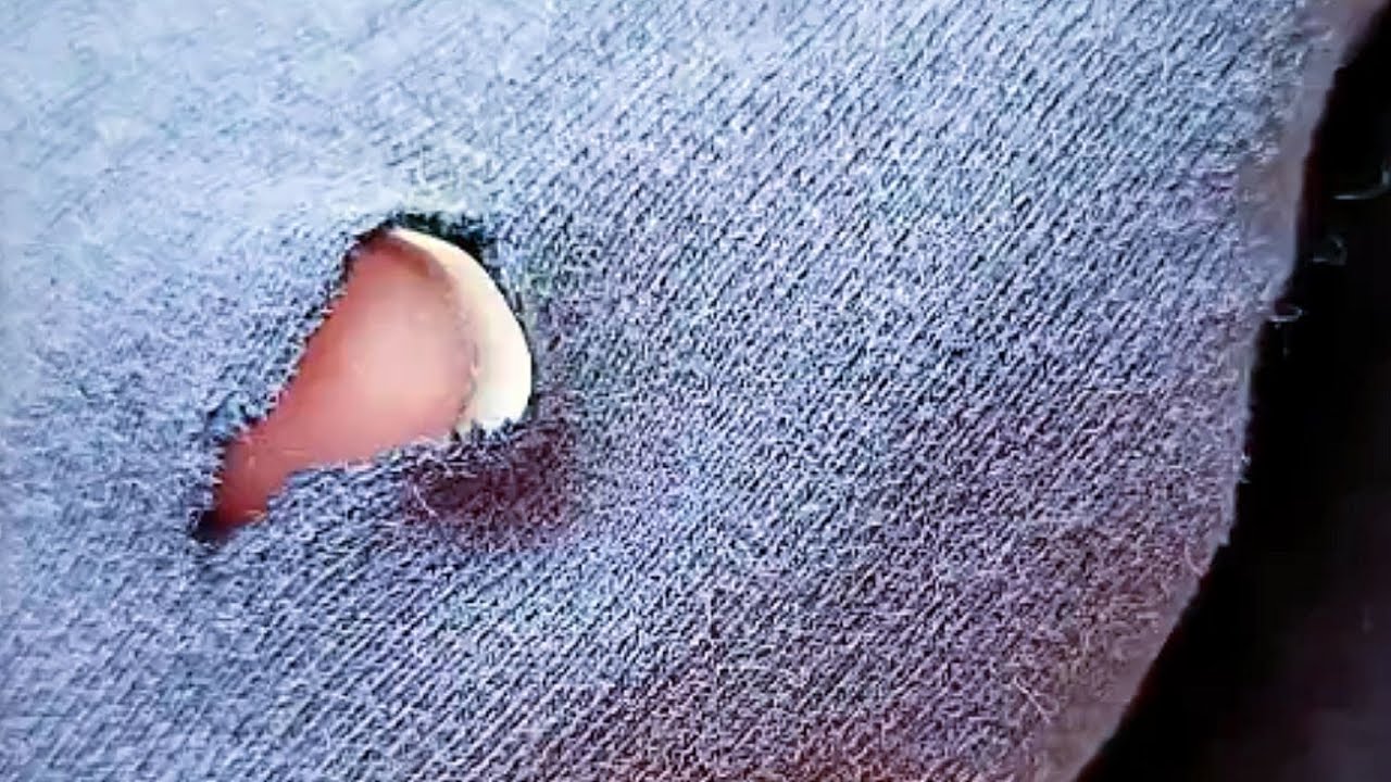 Simple and Practical Invisible Stitch Method for Repairing Holes