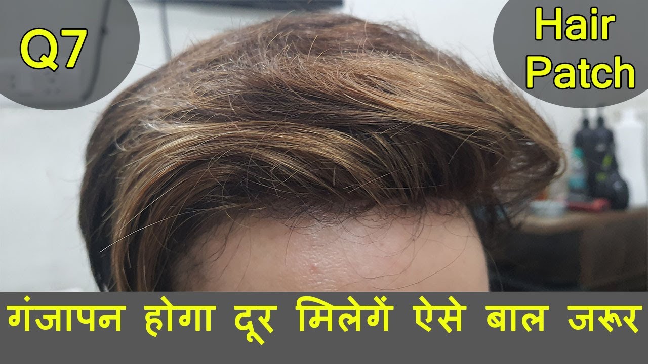 Hair Patch in Bangalore : A Perfect Solution for Baldness & Baldy People