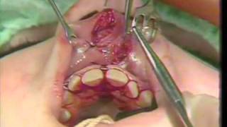 Diastema Closure and Frenectomy With ZPlasty