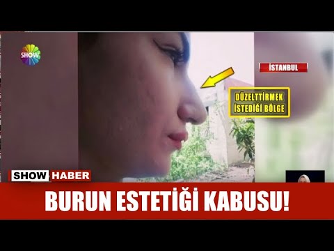 Video: Ciddi Bir Hastalığım Var: Alisa Kazmina Estetik Ameliyattan Sonra Yüzünü Saklamak Zorunda Kalıyor