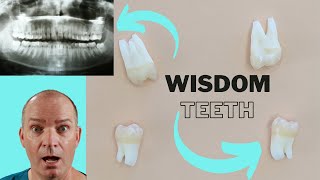 Wisdom teeth on dental x-ray and in real life by Very Nice Smile Dental 1,259 views 8 months ago 3 minutes, 55 seconds