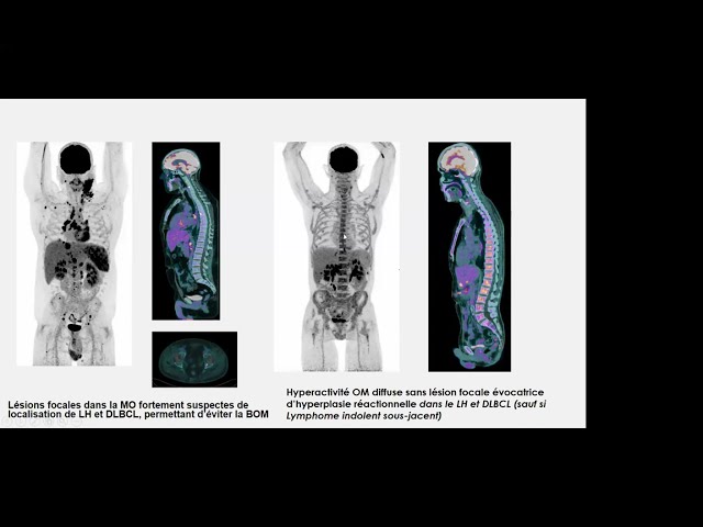 Webinaire AIH -  L'Évaluation métabolique dans le lymphome