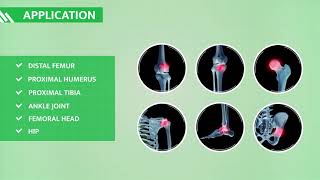 ORTHOPLASTY™ | BPB MEDICA™ - Subchondral Bone Marrow Lesions (BMLs) treatment kit