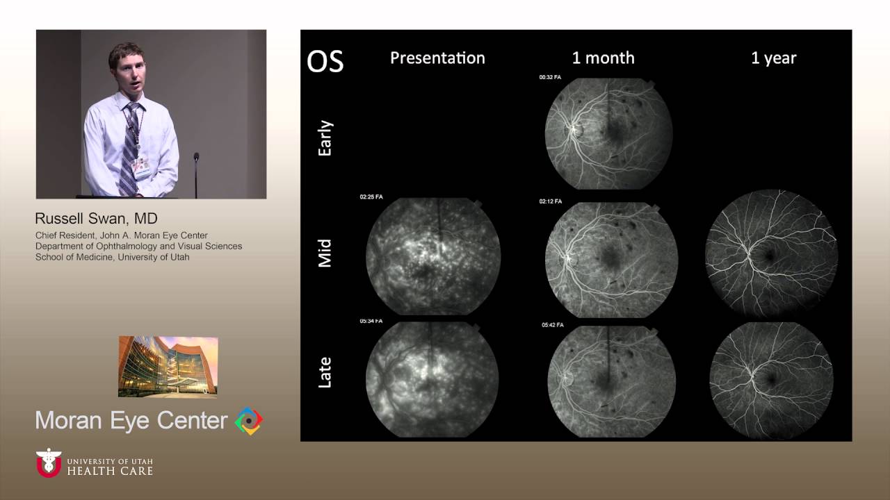 http://clinicaltrials.gov 006 Russell Swan Retinal Manifestations of Juvenile Dermatomyositis