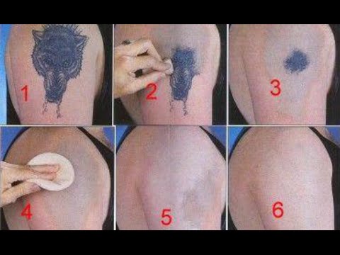 How to Remove a Tattoo without Laser at Home - YouTube