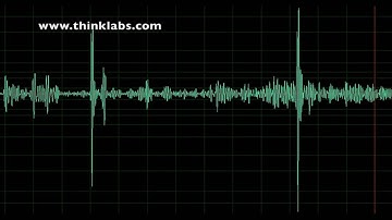 Innocent Systolic Murmur
