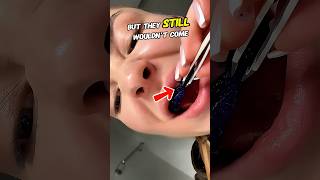 She Used Tweezers… But the Whitening Strips Wouldn't Come Off 😳🦷😂