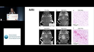Tali Ilovitsh - Microbubble agent oscillation following 250 kHz insonation for BBB opening (2018)