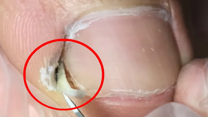 There Is A Ball Of Black Mud Hidden Under The Ingrown Toenail!【Crazy pedicure room】