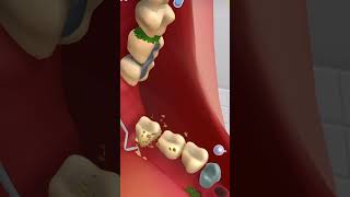 Teeth treatment with animation animation animi satisfying satisfyingvideo