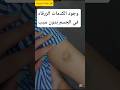 لماذا تظهر الكدمات الزرقاء في جسمك بدون سبب اكسبلور Video Shorts Shortvideo 