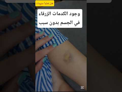لماذا تظهر الكدمات الزرقاء في جسمك بدون سبب اكسبلور   