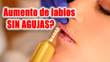 ¿Cómo puedo rellenar mis labios sin Botox?