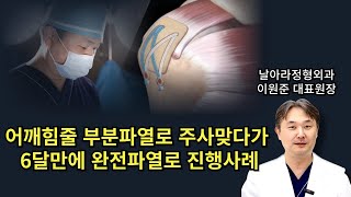 어깨 회전근개파열 주사치료 6달만에 완전파열로 악화사례
