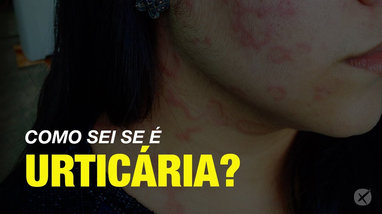 Quais são os sintomas da urticária?