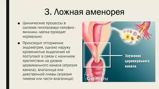 Нарушения менструального цикла. Аменорея. ДМК. Дисменорея.