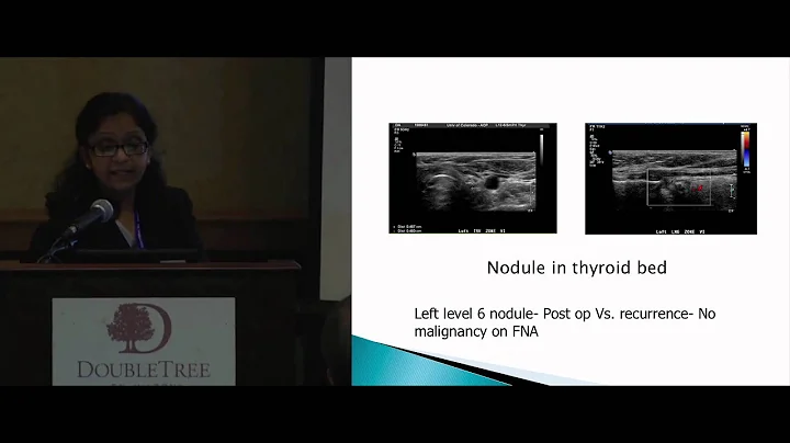 Thyroid Cancer: Lymph Node Evaluation & Mapping, P...
