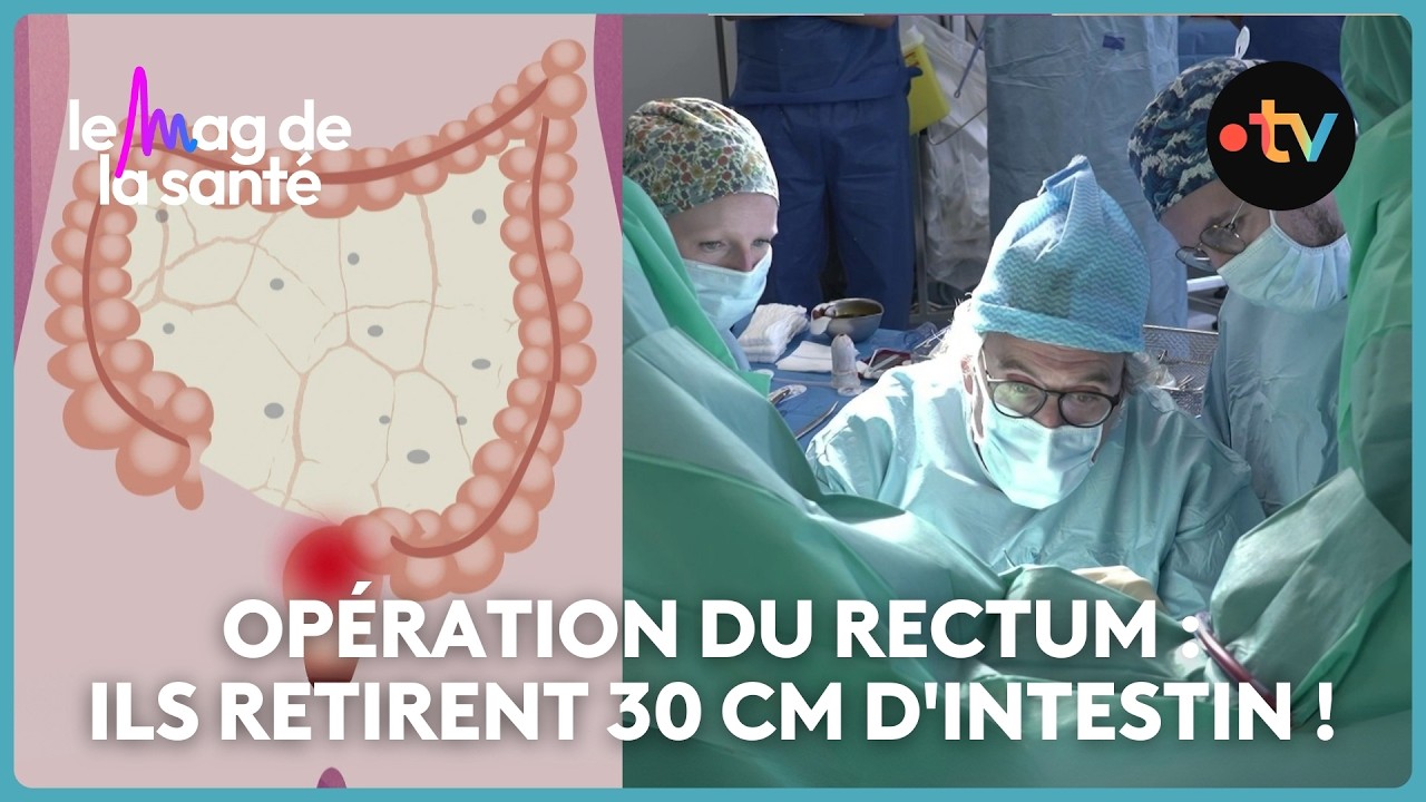 Cancer colorectal : comment se déroule l'opération pour retirer la tumeur ?