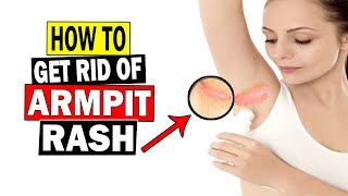 How To Get Rid Of Armpit Rash Naturally At Home || Home Remedies For Armpit Rash Treatment