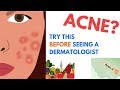 ACNE Treatments | Explained by Dermatologist