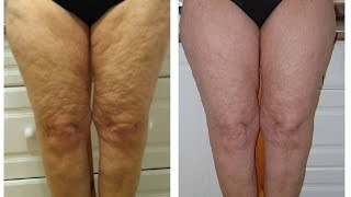 Edematosa condición de piel
