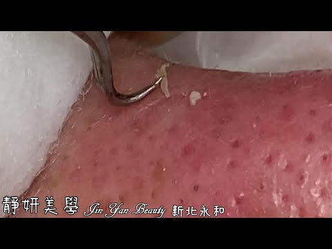 療癒粉刺(Soothing acne)-Taiwan New Taipei City-大台北清粉刺最乾淨