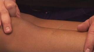 How To Perform Acupuncture screenshot 5