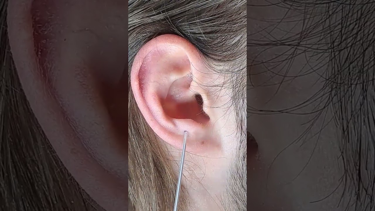 anti-tragus 