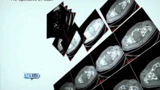 Innovative Makoplasty partial knee replacement outpatient surgery