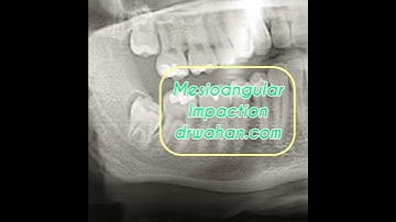 Mesioangular Third Molar Extraction