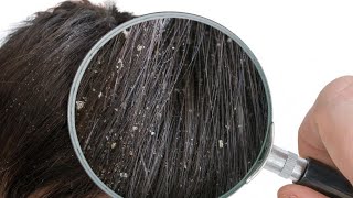 Dandruff? Six home remedies that work by OluwaPlenty A 6 views 6 years ago 1 minute, 15 seconds