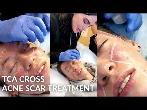 TCA Cross / Acne Scar Treatment Beverly Hills, CA / Darker Skin / Los Angeles