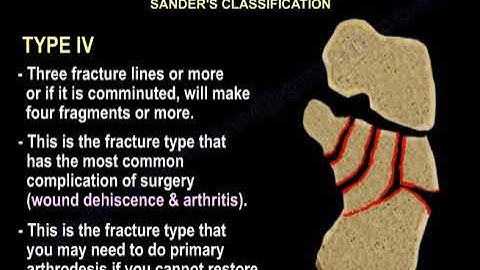 Fractures of the Calcaneus - Everything You Need To Know - Dr. Nabil Ebraheim