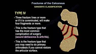 Fractures of the Calcaneus - Everything You Need To Know - Dr. Nabil Ebraheim