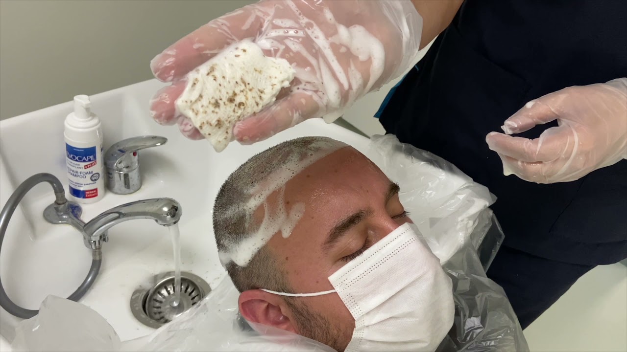 Saç ekimi sonrası 10. günde kabuk dökme işlemi. Shedding Cruts after Hair Transplant end of 10 days