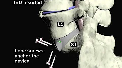 Anterior Lumbar Interbody Fusion (ALIF Part 3) Animation by Cal Shipley, M.D.