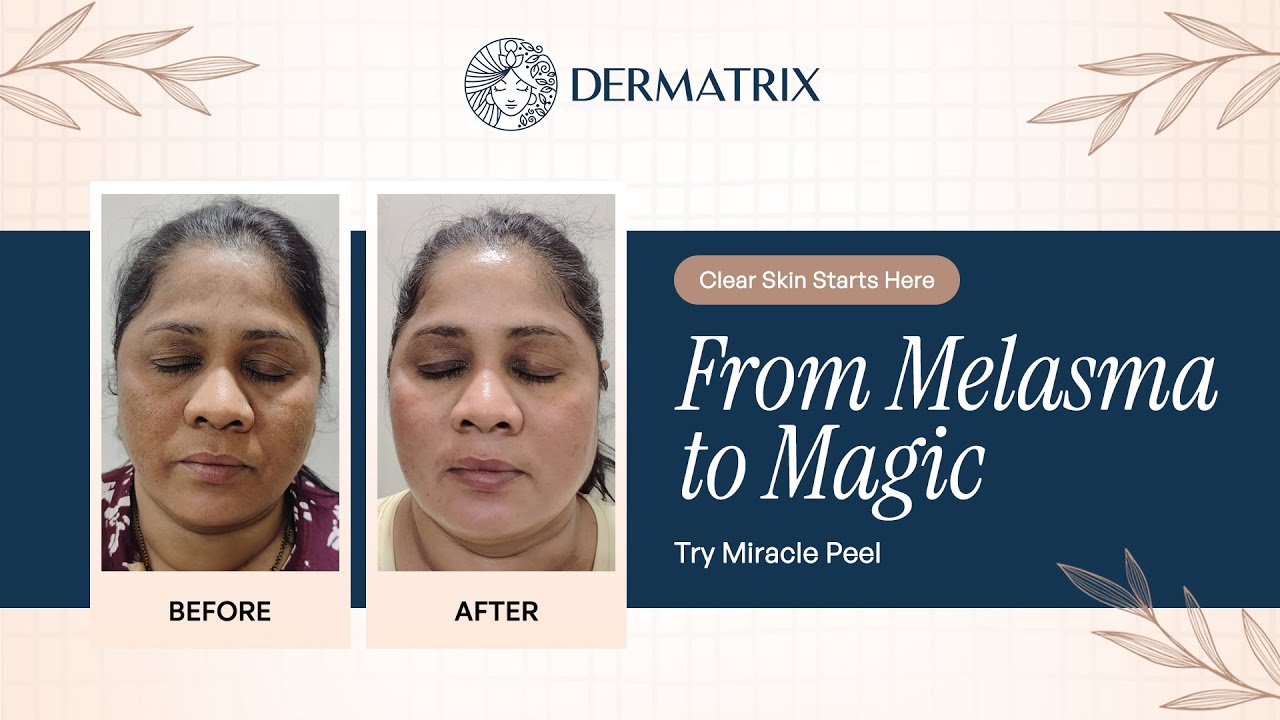 Miracle Peel for Melasma | Safe & Effective Chemical Peel Treatment at Dermatrix
