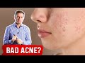 If Nothing is Working for Acne, Try This Acne Removal Treatment – Dr.Berg